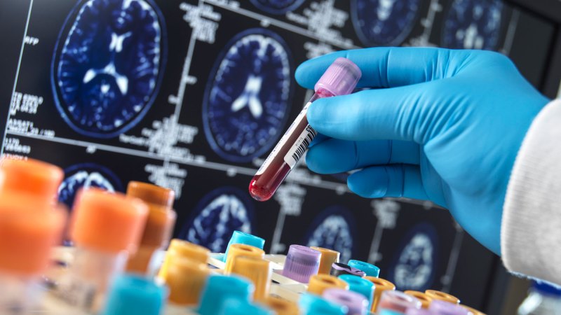 Source-feed image associated with A blood test for dementia may tell you if you have more than one type