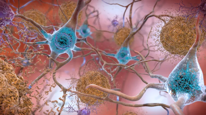 Source-feed image associated with A new sort of Alzheimer’s drug shows glimmers of promise