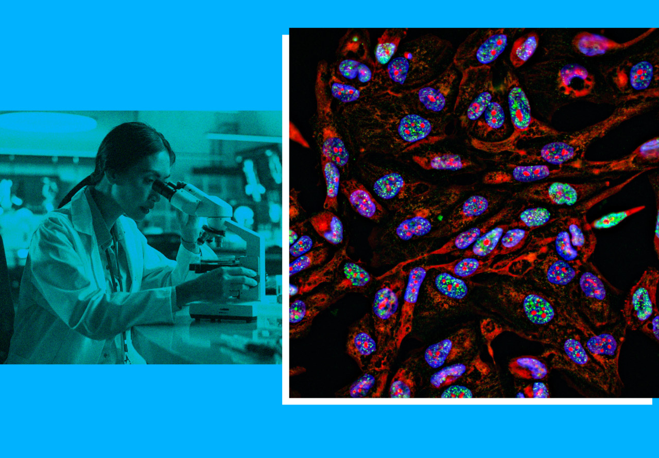 Source-feed image associated with Moderna’s personalized mRNA shot could reshape the fight against skin cancer — but it may also be overhyped