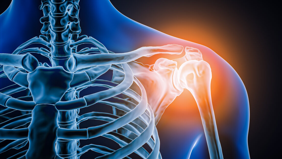 Source-feed image associated with Doctors took a look at man's painful shoulder—they found the joint was missing