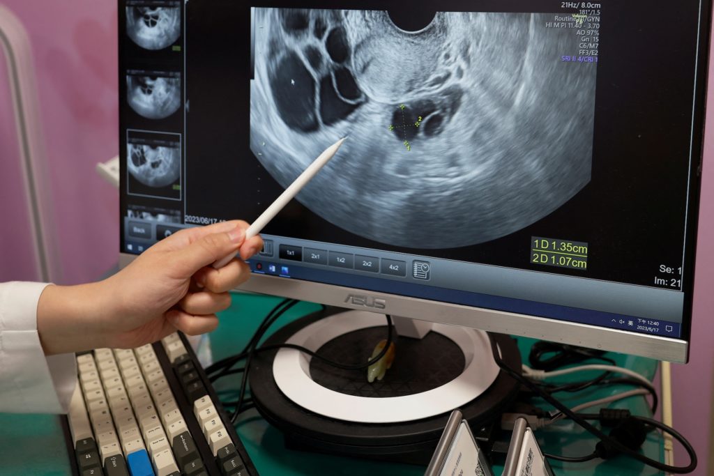 Source-feed image associated with How new findings on ovarian cancer origins may help reduce risk
