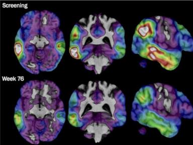 Source-feed image associated with Experimental Alzheimer's drug shows some promise as researchers hunt new approaches