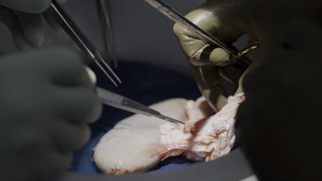 Source-feed image associated with STAT+: Recipients of gene-edited pig kidneys successfully receive human organs