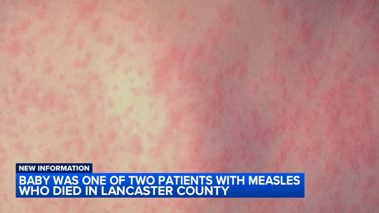 Source-feed image associated with Baby among 2 unvaccinated measles deaths in Lancaster County, Pennsylvania