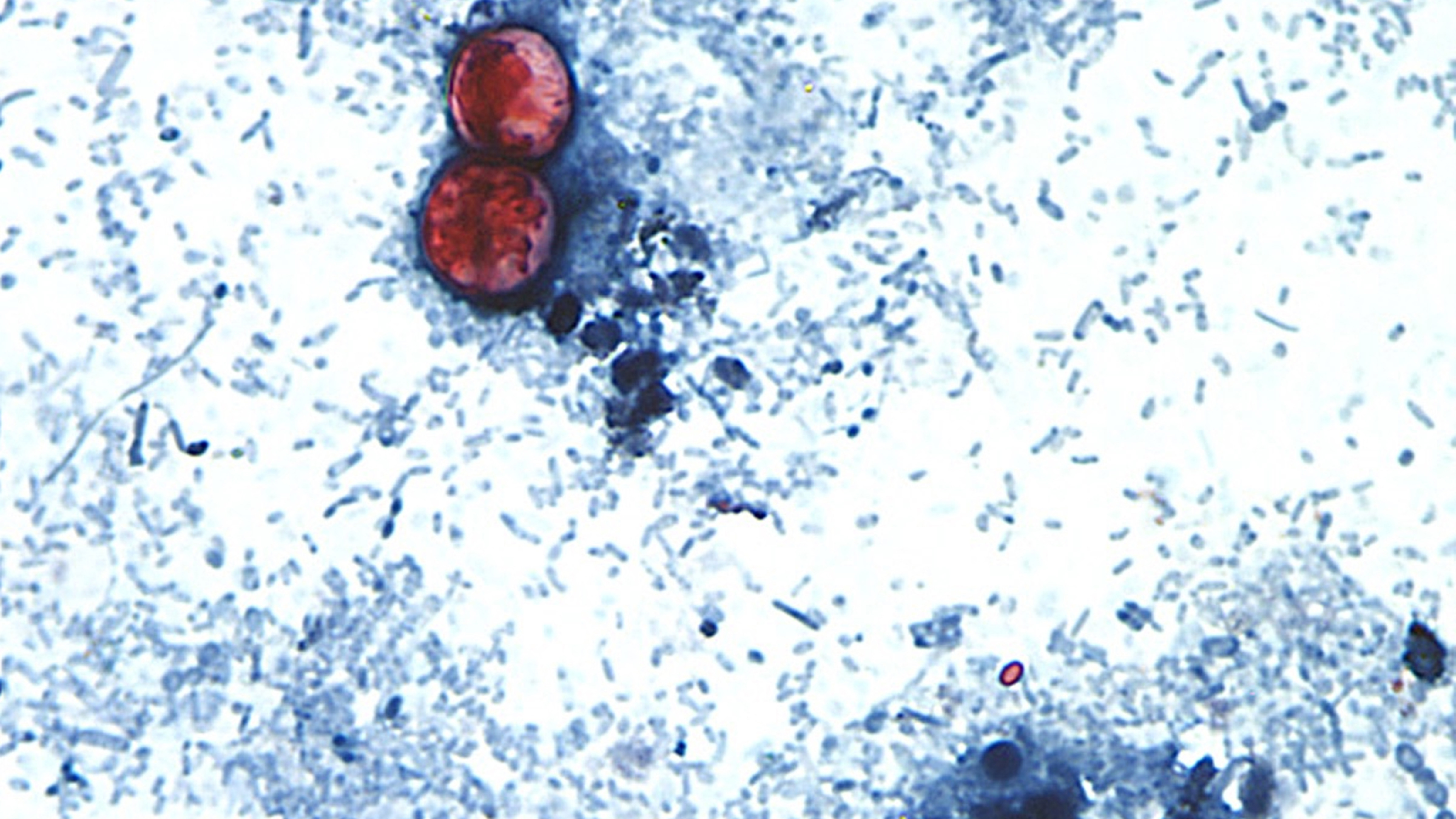 Source-feed image associated with More than 18,000 cyclosporiasis cases reported across 45 states: CDC