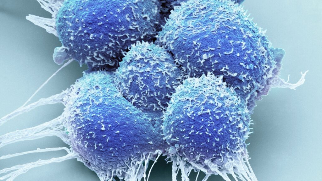 Source-feed image associated with Focal therapy for localized prostate cancer has divided physicians. Will new data change minds?