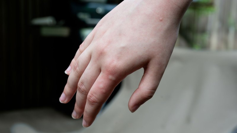 Source-feed image associated with Your skin chemistry may affect which mosquitoes most want to bite you