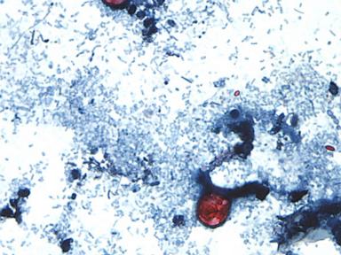 Source-feed image associated with Outbreak of diarrhea-causing parasite grows to more than 1,000 cases