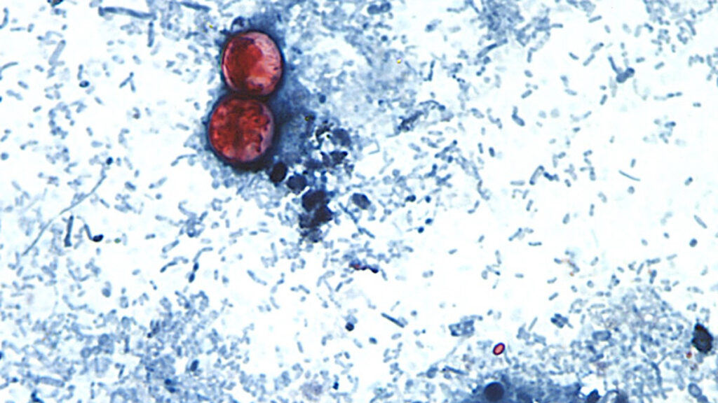 Source-feed image associated with Outbreak of diarrhea-causing parasite grows to more than 1,000 cases
