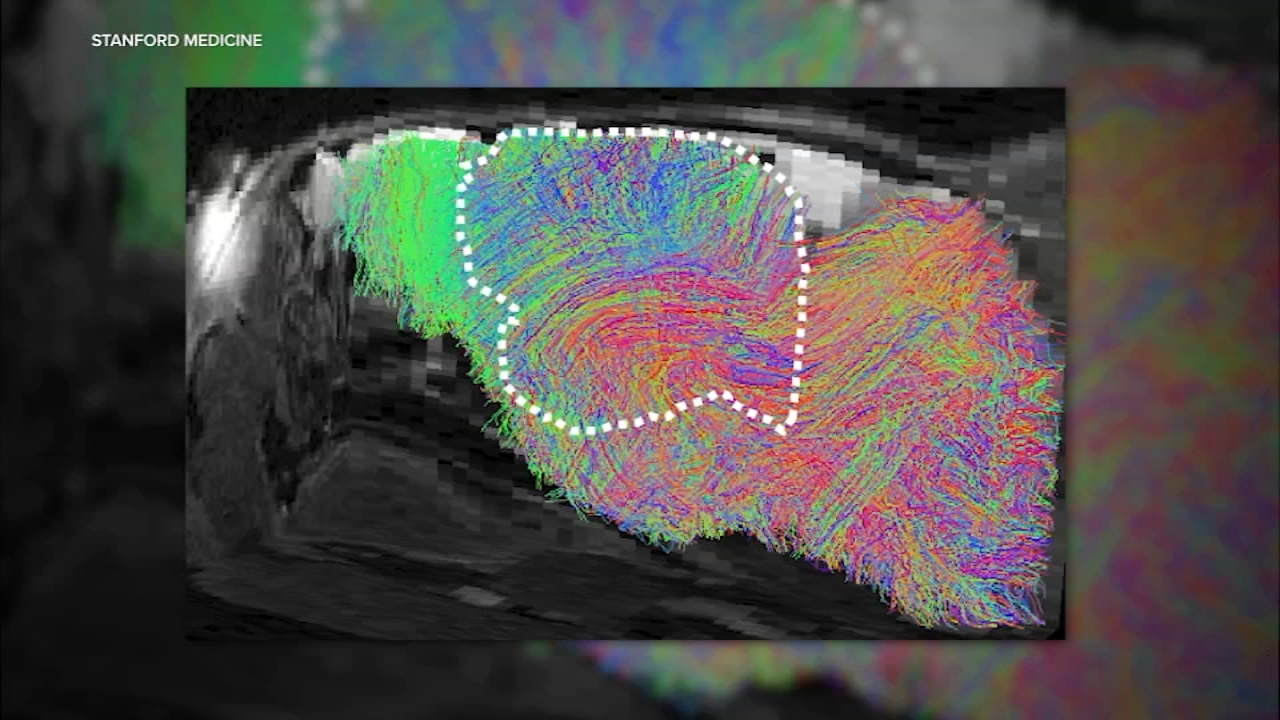 Source-feed image associated with Stanford researchers successfully grow human brain tissue inside mice in new study