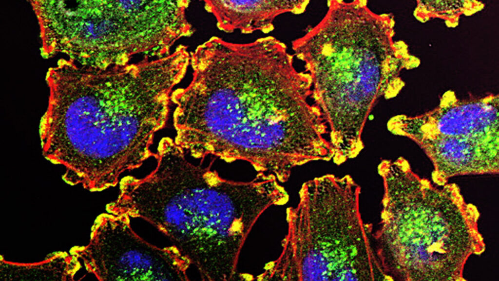 Image from linked report: After a melanoma diagnosis, mRNA cancer vaccine delivered a patient hope — and a path forward