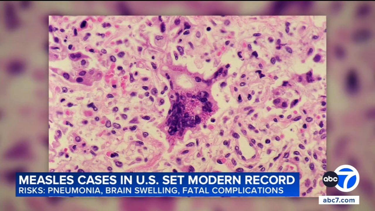 Source-feed image associated with US measles cases reach 35-year high, for second record-breaking year in a row