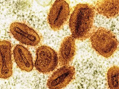 Source-feed image associated with Scientists charged with bringing deactivated mpox virus into US, lying to authorities
