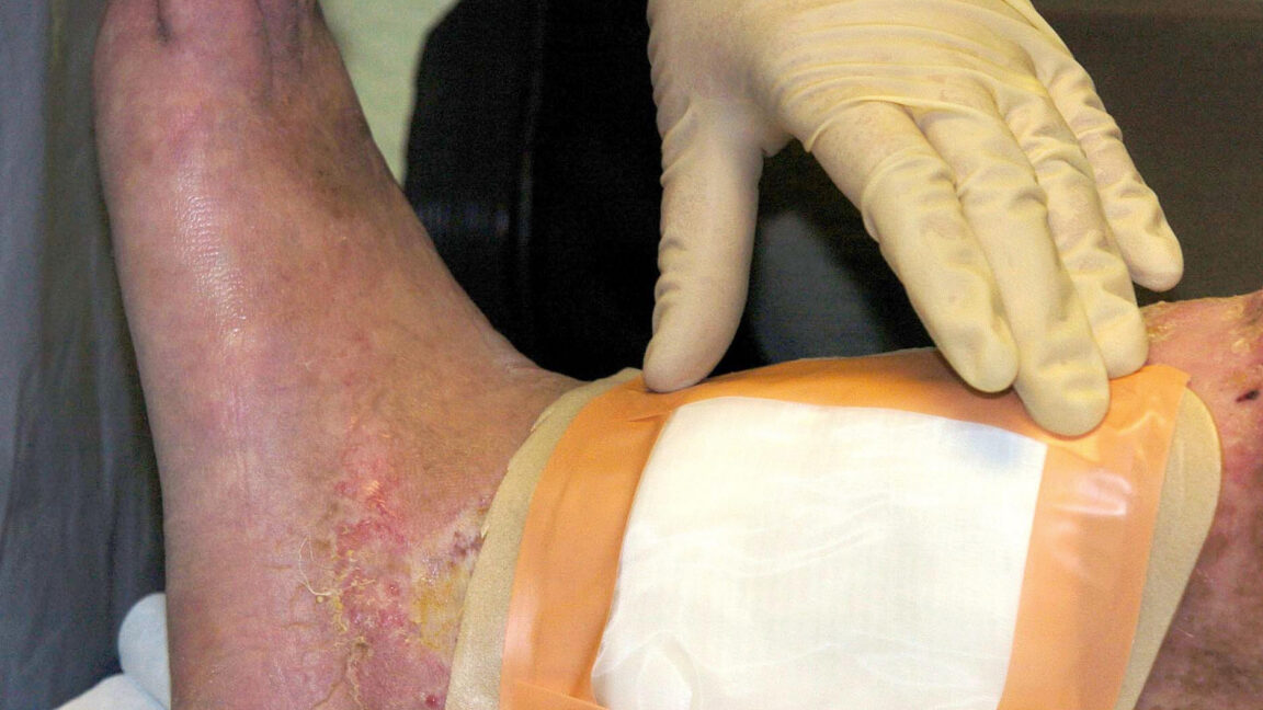 Source-feed image associated with Second carcass-eating fly species cleared by FDA for maggot wound therapy