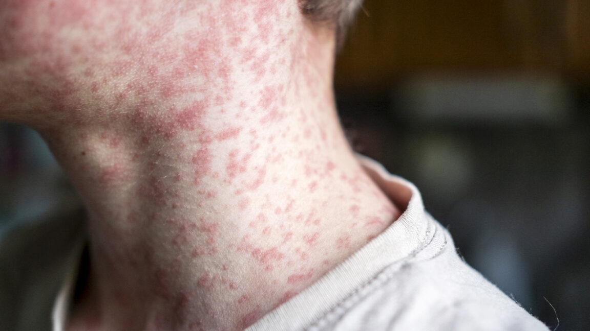 Source-feed image associated with 18-year-old dies of measles in PA from severe neurological complication