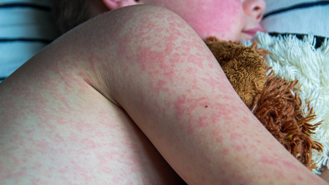 Source-feed image associated with Two unvaccinated people die from measles in Pennsylvania, officials confirm