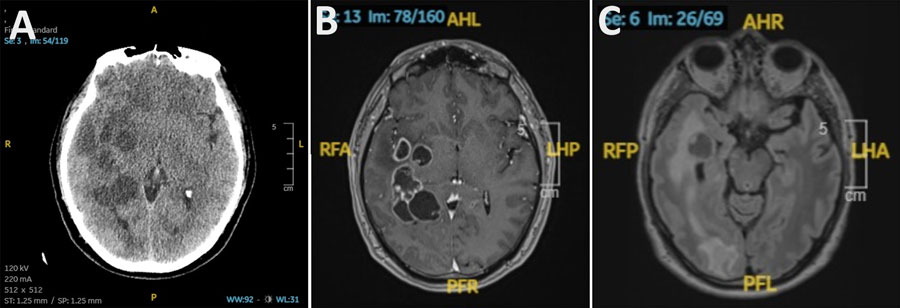Source-feed image associated with Doctors suspected man had brain cancer. He actually had worms.