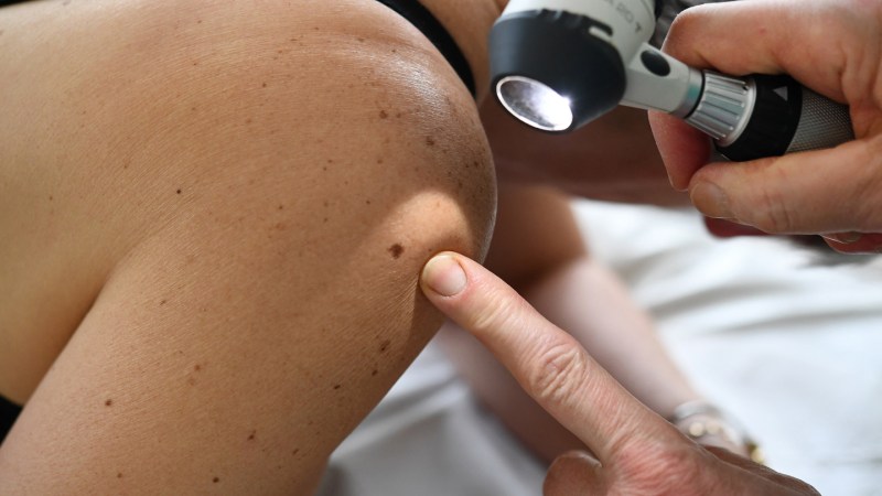 Source-feed image associated with A new cancer vaccine may keep melanoma from coming back